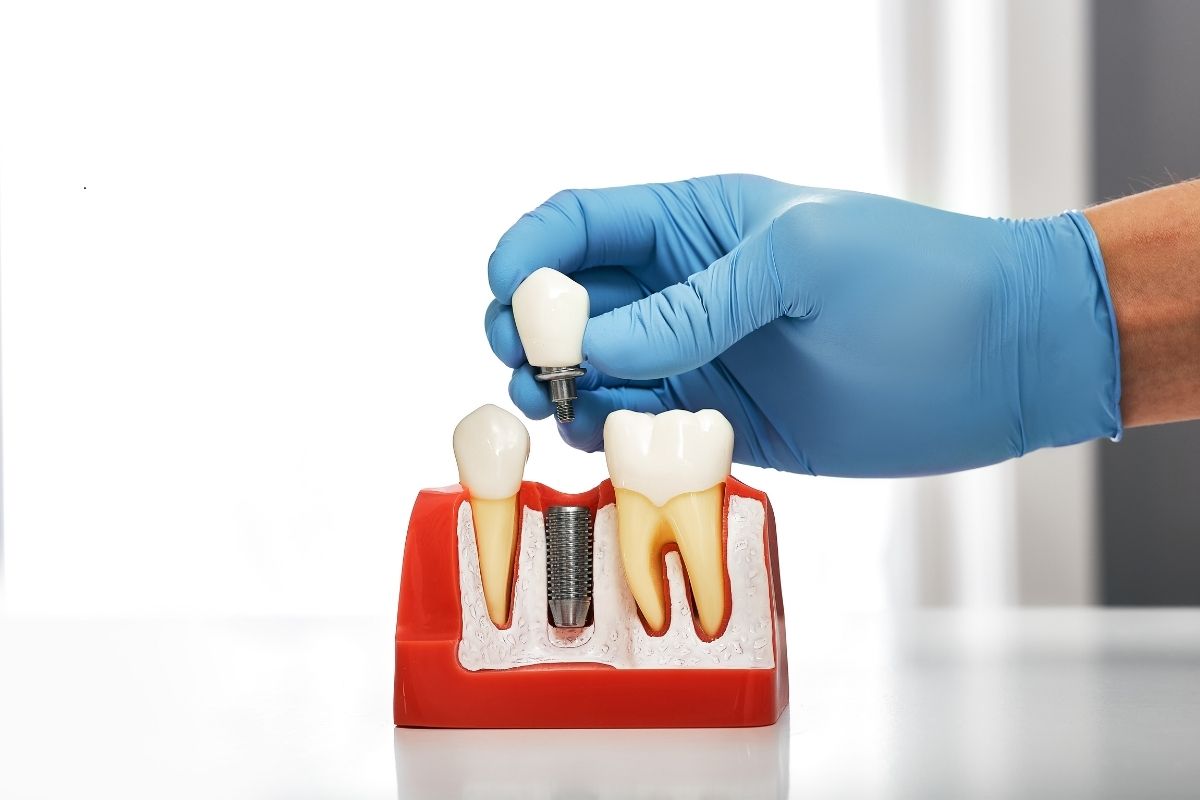 Dental Implants Chandler